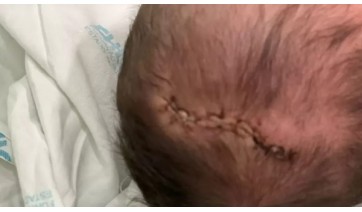 Bebê cai de cabeça após parto, tem traumatismo craniano e mãe aponta negligência do hospital, em MG