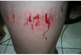 Mulher teve ferimentos, ao passar sobre bueiro que afundou, na Vila Jardim (Foto: Facebook/Liandra Brandão).