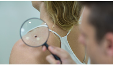 Câncer de pele: veja o passo a passo para identificar sinais suspeitos