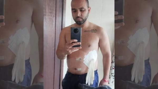 Luva cirúrgica, ao invés da bolsa de colostomia. Médico disse que era medicina de guerra (Acervo Pessoal).
