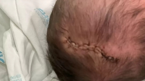 Bebê levou 11 pontos na cabeça após cirurgia (Acervo Pessoal).
