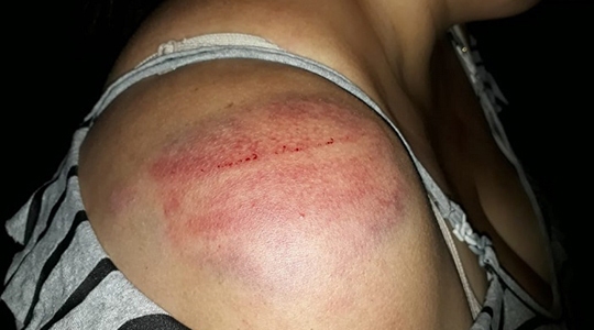 Marcas da agressão no corpo da mulher (Foto: Cedida/PM).