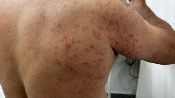 Homem ficou com mascas das ferroadas pelo corpo (Foto: Renato Campanari/TV Fronteira).