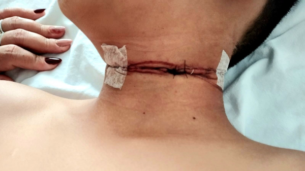 Corte atingiu o pescoco do menino (Reproducao/Dernival Manfio).