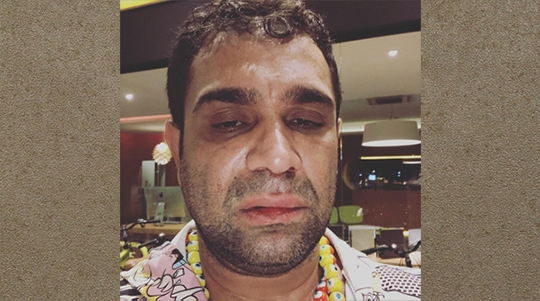 Evandro Santo ficou com o rosto machucado após agressão, em Marília (Reprodução/Instagram).