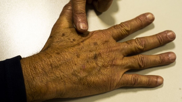 Custo do tratamento gira em torno de R$ 200 a R$ 300 por lesão de pele com até um centímetro (Marcello Casal JrAgência Brasil).