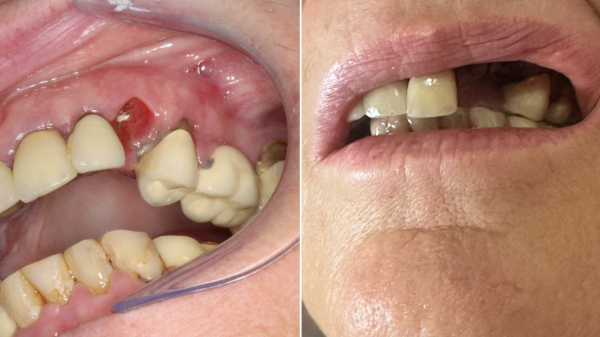 Professora teve protese arrancada depois de ser atingida com soco pela criana (Cedida).