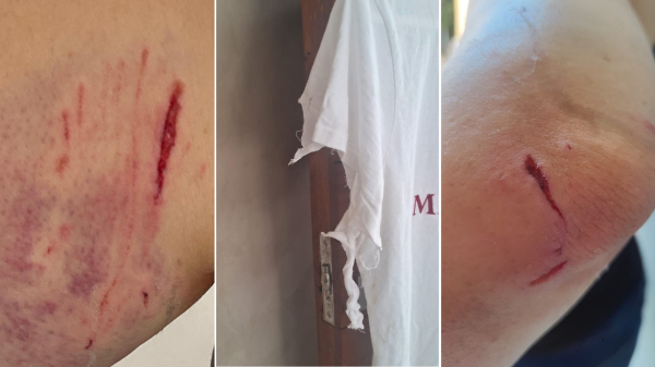 Ferimentos e roupas rasgadas no ataque sofrido pela vitima no Parque dos Pioneiros (Cedidas).