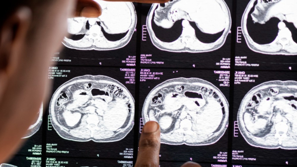 No Brasil, foram registradas mais de 185 mil interna??es e 35.868 mortes por AVC no ano de 2022 (Imagem: Rawpixel.Com/Freepik).
