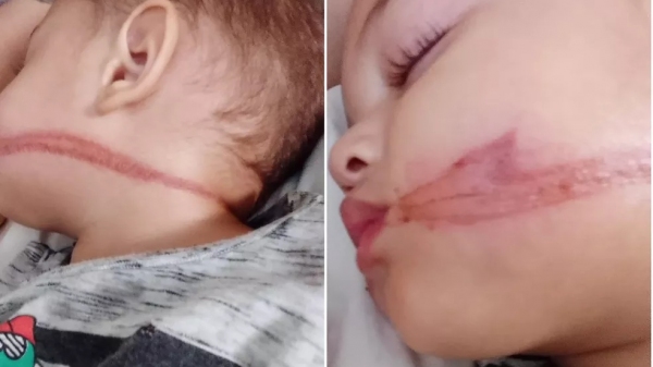 Bebês gêmeos feridos no rosto pela fiação exposta na rua, que ricocheteou quando foi atingida por carro (Acervo Pessoal).