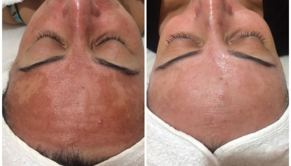 Melasma, antes e depois das sessões, com a esteticista Luciana Ápplim (Divulgação).