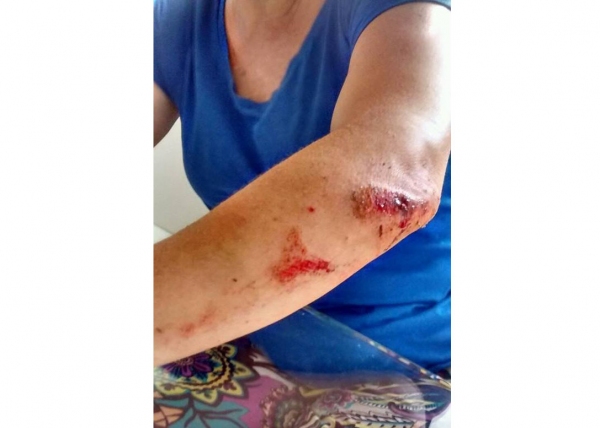 Mulher de 54 anos ficou ferida após cair em buraco na rua, em Adamantina (Foto: Cedida).