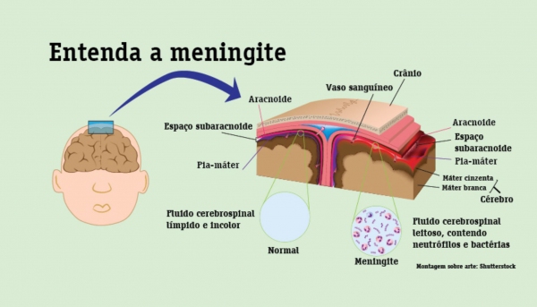 Dracena confirma caso de meningite bacteriana em criança de 9 anos