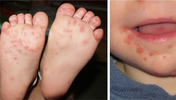 Doença causa bolhas nas mãos, pés e região da boca (Ilustração).