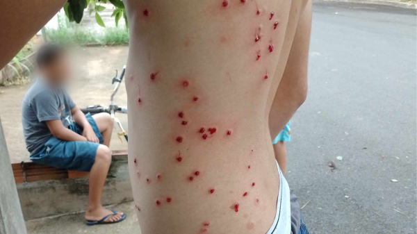 Marcas dos disparos no corpo do rapaz (Cedida).