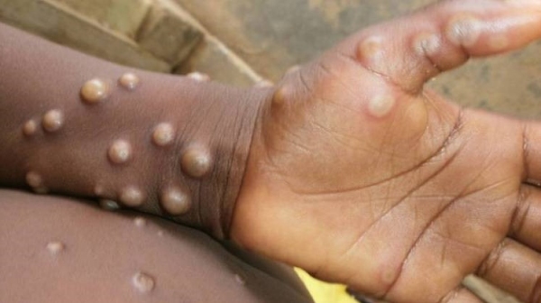 Casos de varÃola do macaco têm sido registrados em alguns paÃses africanos (OMS/Centro de Controle de Doenças da Nigéria).